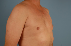 Male Breast Reduction Before & After Image