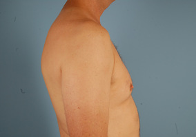 Male Breast Reduction Before & After Image