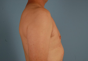 Male Breast Reduction Before & After Image