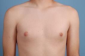 Male Breast Reduction Before & After Image