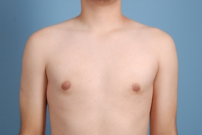 Male Breast Reduction Before & After Image