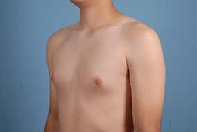 Male Breast Reduction Before & After Image