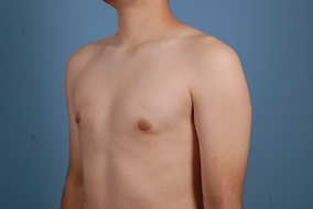 Male Breast Reduction Before & After Image