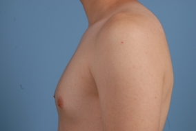 Male Breast Reduction Before & After Image