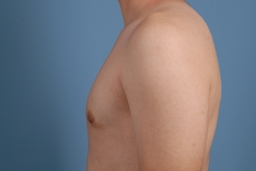 Male Breast Reduction Before & After Image