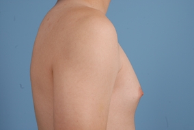 Male Breast Reduction Before & After Image