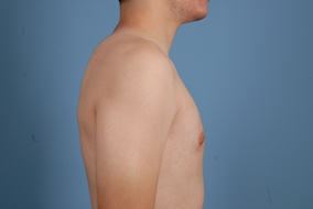 Male Breast Reduction Before & After Image