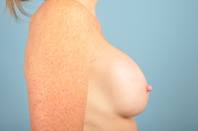 Breast Augmentation Revision Before & After Image
