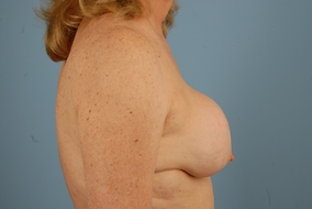 Breast Augmentation Revision Before & After Image