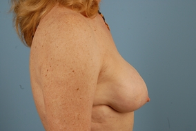 Breast Augmentation Revision Before & After Image