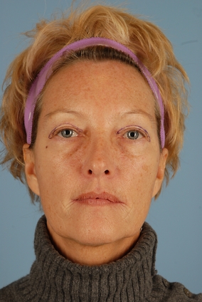 Blepharoplasty Before & After Image