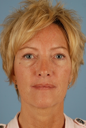 Blepharoplasty Before & After Image