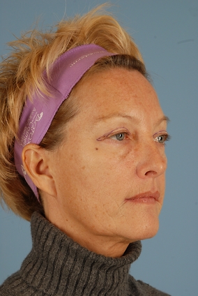 Blepharoplasty Before & After Image