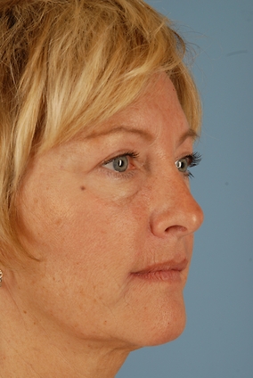 Blepharoplasty Before & After Image