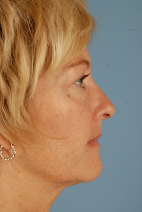 Blepharoplasty Before & After Image