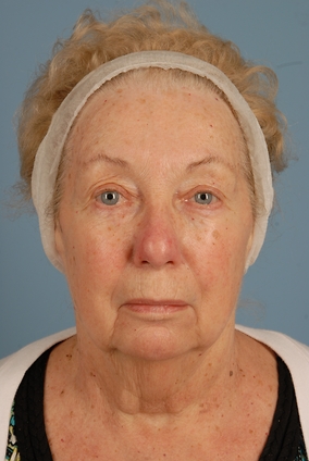 Blepharoplasty Before & After Image