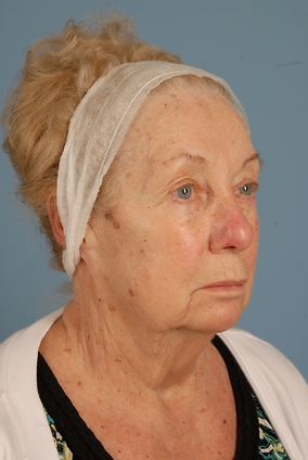 Blepharoplasty Before & After Image