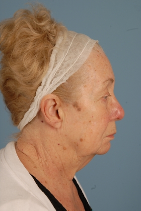 Blepharoplasty Before & After Image