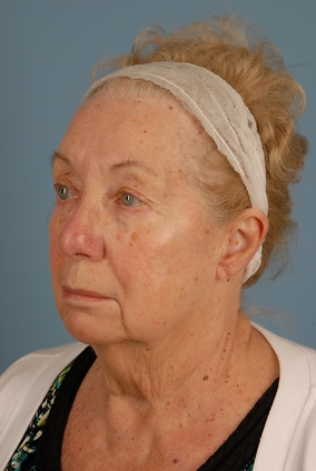 Blepharoplasty Before & After Image