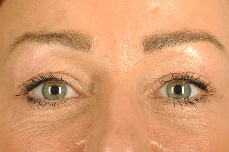 Blepharoplasty Before & After Image