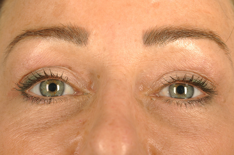 Blepharoplasty Before & After Image