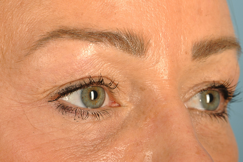 Blepharoplasty Before & After Image