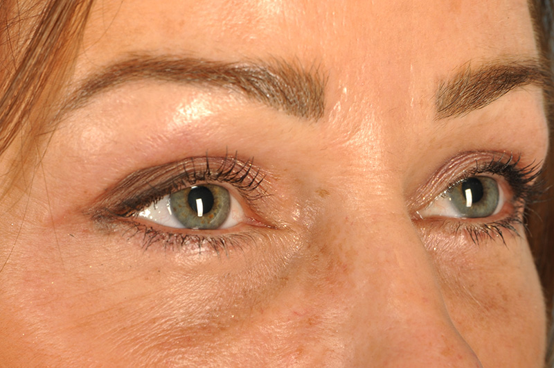 Blepharoplasty Before & After Image