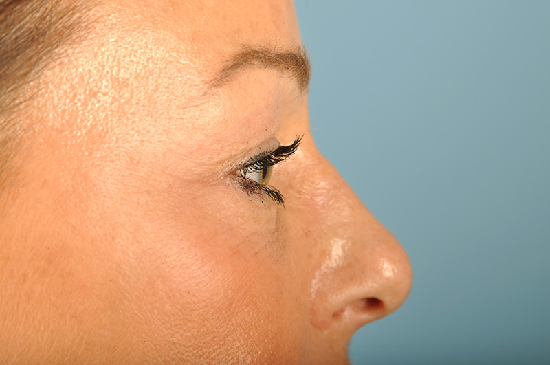 Blepharoplasty Before & After Image