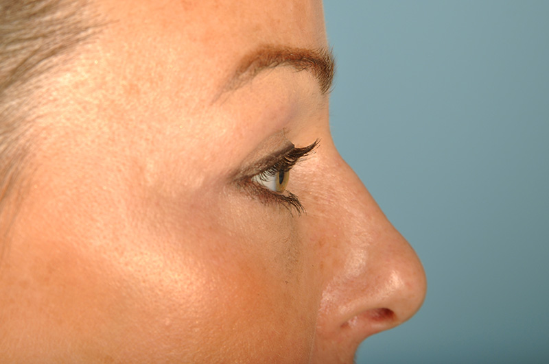 Blepharoplasty Before & After Image