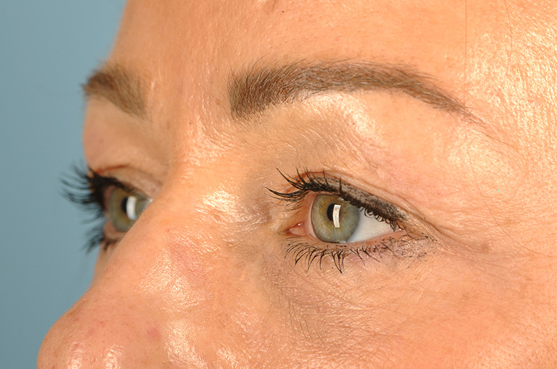 Blepharoplasty Before & After Image