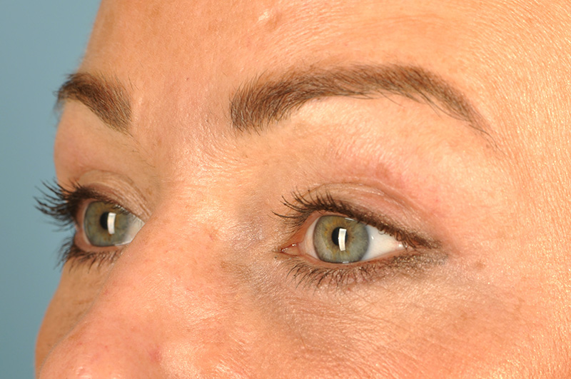 Blepharoplasty Before & After Image