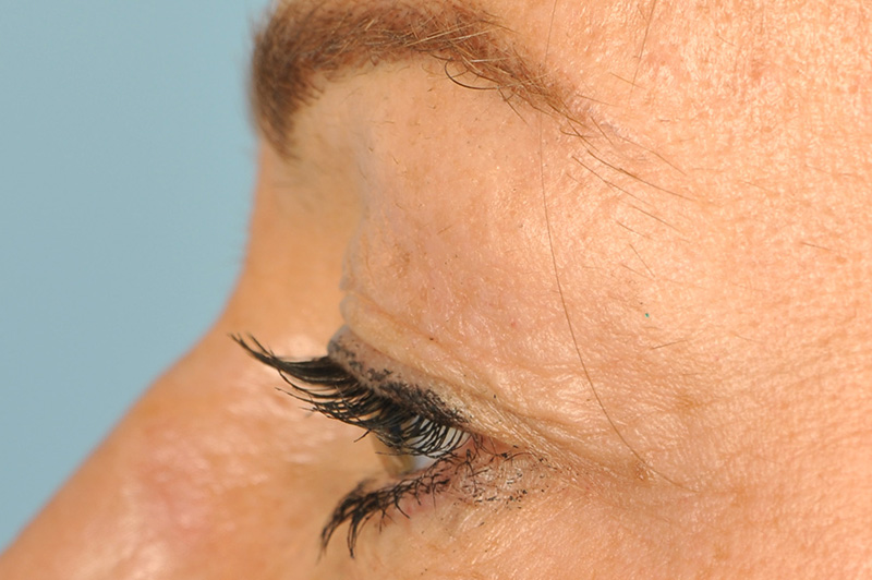 Blepharoplasty Before & After Image