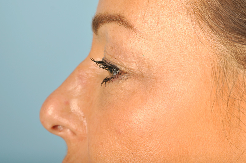 Blepharoplasty Before & After Image
