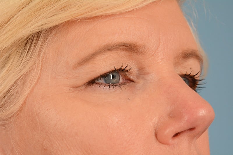 Blepharoplasty Before & After Image