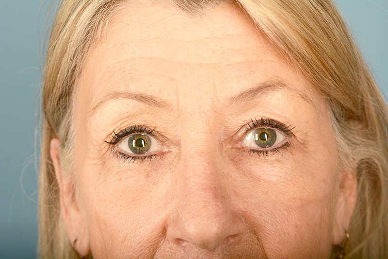 Blepharoplasty Before & After Image