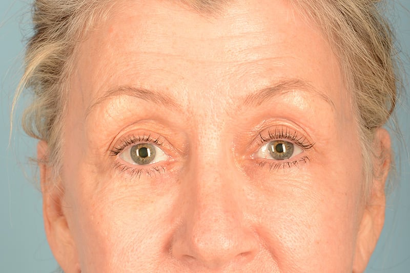 Blepharoplasty Before & After Image