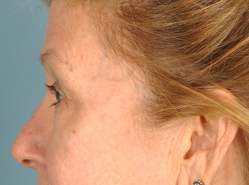 Blepharoplasty Before & After Image