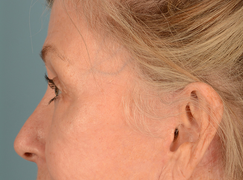 Blepharoplasty Before & After Image