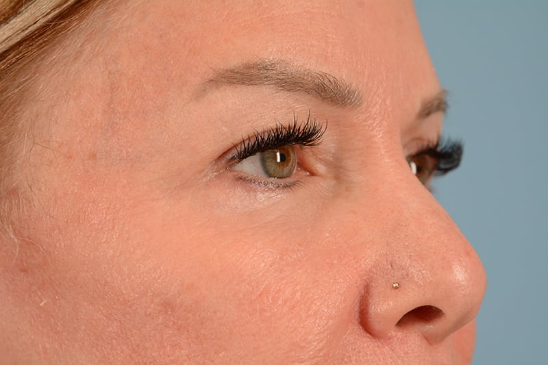 Blepharoplasty Before & After Image