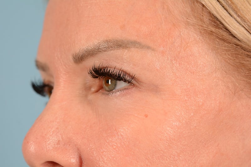 Blepharoplasty Before & After Image