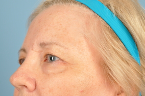 Brow Lift Before & After Image