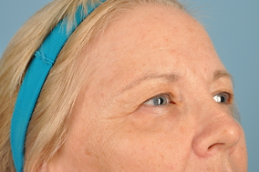 Brow Lift Before & After Image