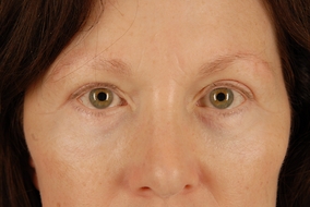 Brow Lift Before & After Image