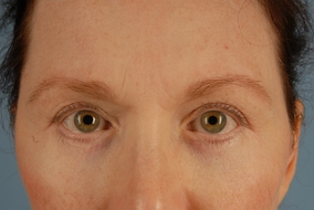 Brow Lift Before & After Image