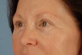 Brow Lift Before & After Image