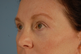 Brow Lift Before & After Image