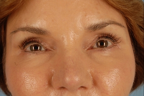 Brow Lift Before & After Image