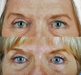 Brow Lift Before & After Image