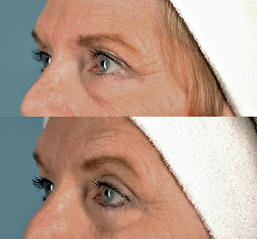 Brow Lift Before & After Image