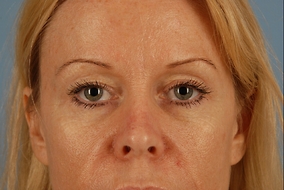 Brow Lift Before & After Image